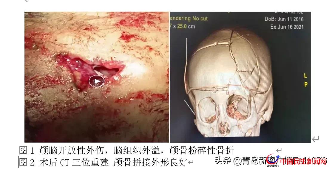 5歲男童6樓墜落命懸一線，婦兒醫(yī)院多學科協(xié)作再勝“死神”